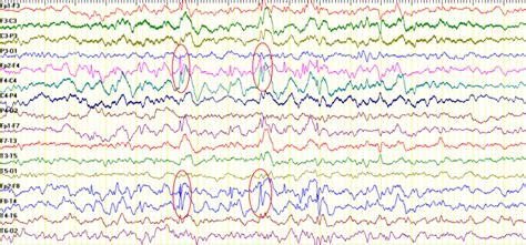 Pre Radiosurgery Interictal Electroencephalogram Showing Sharp Waves