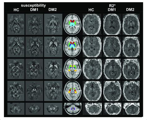 Mri Based Imaging Techniques Of The Brain Examples Of Susceptibility