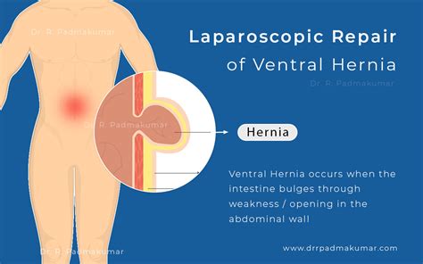 Ventral Hernia Repair And Treatment Dr R Padmakumar
