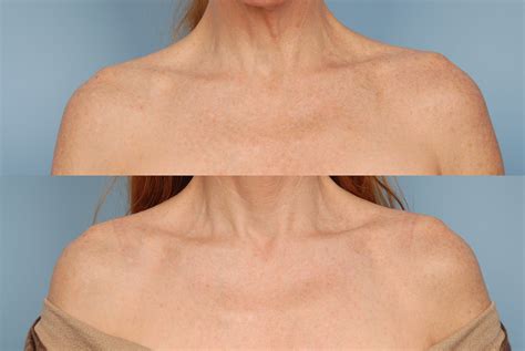 Active Fx Laser Before And After Photos Grossman Dermatology