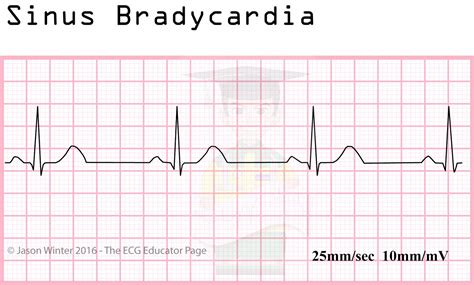 Ecg Educator Blog Sinoatrial Node Rhythms