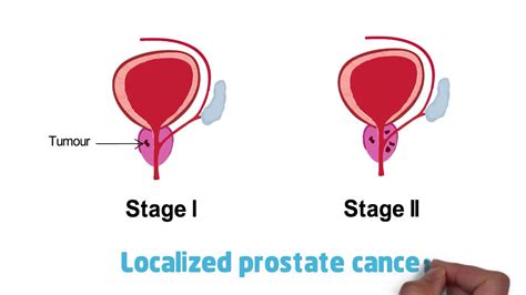 Understanding Prostate Cancer Youtube