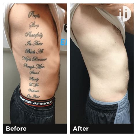 Tattoo Removal Before And After Laser Tattoo Removal Plastic Surgeon