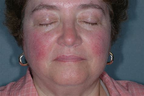 Erythematotelangiectatic Rosacea Note Central Facial Erythema Most