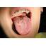 What Is A Geographic Tongue  Ask An Orthodontistcom