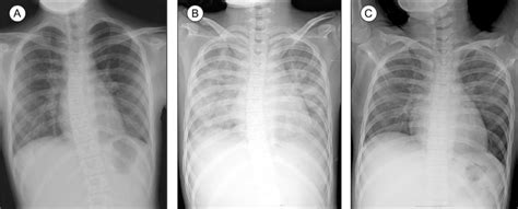 The Chest Pa Radiograph Shows Haziness Of Both Lungs The Pneumonia