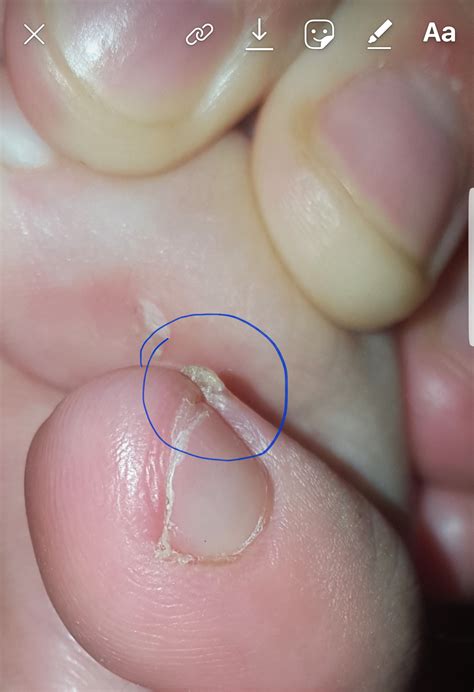 Hard Piece Of Skin On My Foot What It Is I Know My Feet