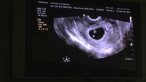 Pregnancy Ultrasound At 8 To 9 Weeks With Heart Beat Youtube