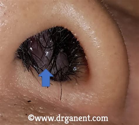 What Are Nasal Polyps Images Included Dr Gan Eng Cern