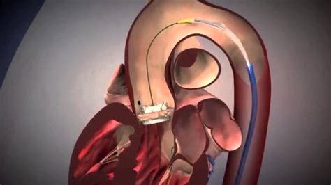 Advancing Aortic Stenosis Treatment Using Tavr With Dr Alan Malki