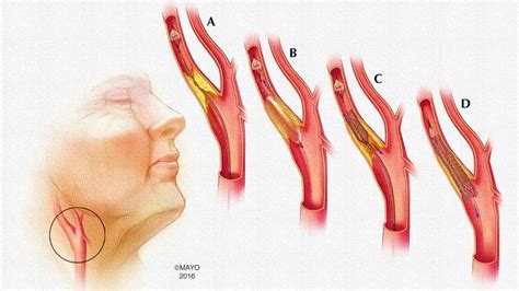 Carotid Artery Disease Stenting