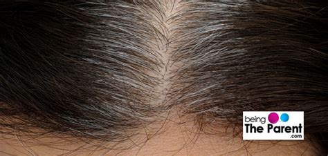Premature Grey Hair In Children Causes And Remedies Being The Parent