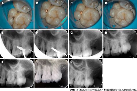 Figure 3 From Endodontic Management Of A Fused Left Maxillary Second
