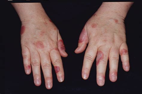 Derm Dx Blisters Blotches And Burning In A 42 Year Old Woman