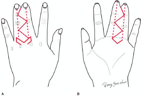 Illustrations Depicting The Markings For Dorsal And Palmar Incisions