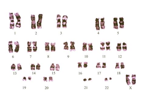 Philadelphia Chromosome Photograph By Dept Of Clinical Cytogenetics