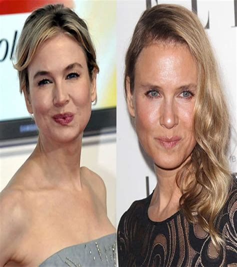 60 Worst Cases Of Celebrity Plastic Surgery Gone Wrong