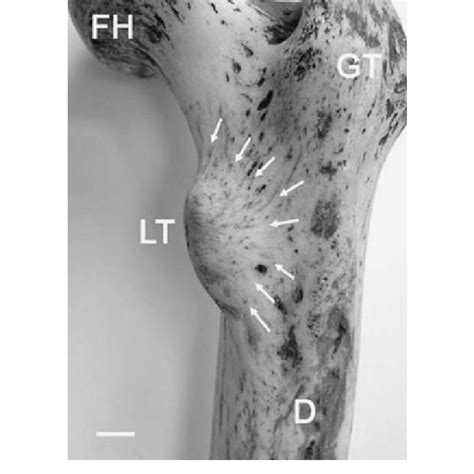 Posterolateral Aspect Of The Lesser Trochanter Of The Right Femur