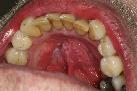 25 Potentially Malignant Disorders Pocket Dentistry