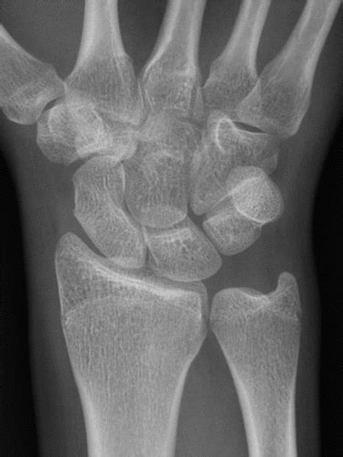 Pediatric Distal Forearm And Wrist Injury An Imaging Review