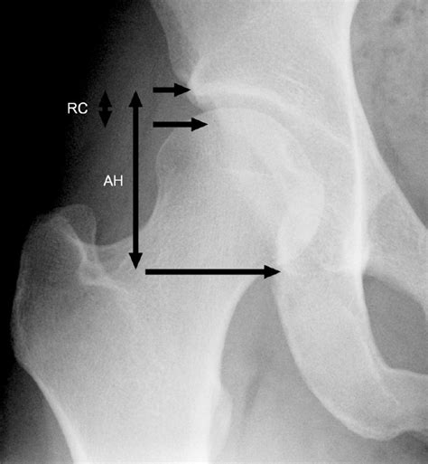 Section Of A Weight Bearing Anteroposterior Pelvic Radiograph Showing