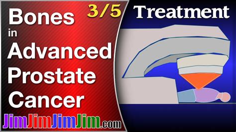 Treatment For Metastatic Prostate Cancer In The Bones Youtube