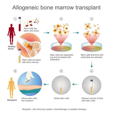 In the united states, over 20,000 patients per year receive allogenic hematopoietic stem cell transplantation (ahsct) as a cure for hematological disorders. Series B Funding Helps Dutch Biotech Fight Graft Versus ...