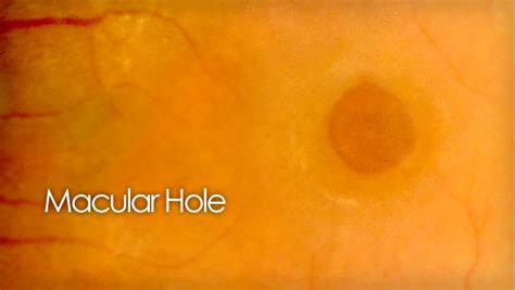 Macular Hole A Patients Guide Of Causes And Treatments