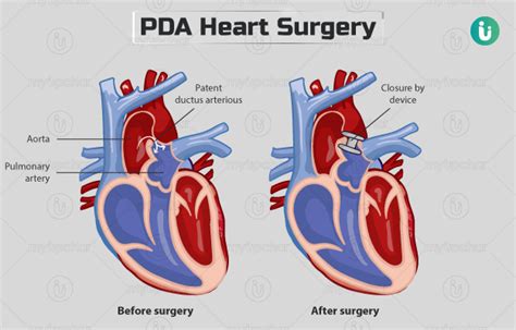 Patent Ductus Arteriosus Pda Heart Surgery Procedure Purpose