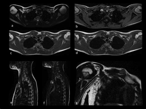 Axial T2 Fat Saturated A And T1 Gradient Echo B Weighted Images