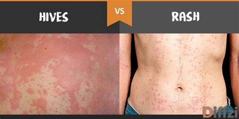 Hives Rash Lupus Body Rash Update Lupus Lyfe Whereas A Rash Is A