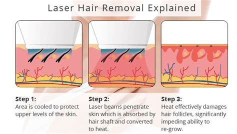 How To Prepare For Laser Hair Removal Patch Test How To Prepare For