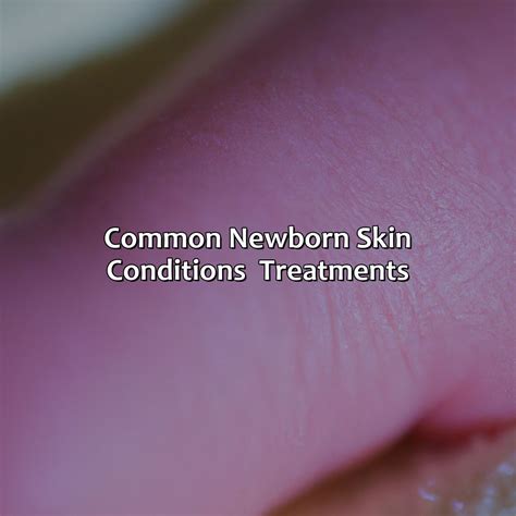 Common Newborn Skin Conditions And Treatments Newborn Tips About
