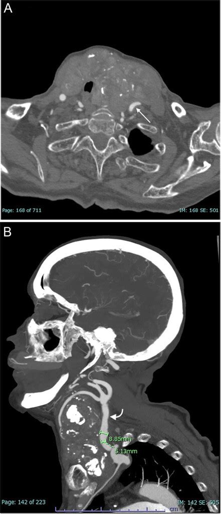 Ischemic Stroke A Rare Complication Of A Large Multinodular Goiter In