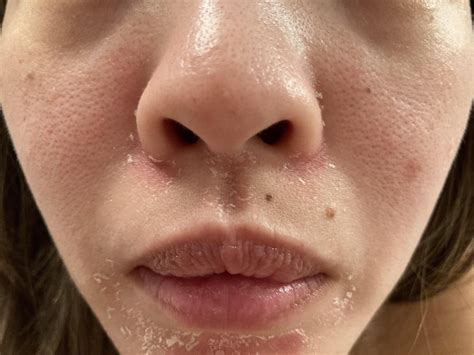 Skin Concerns Help Peeling Skin Around Mouth Rskincareaddiction