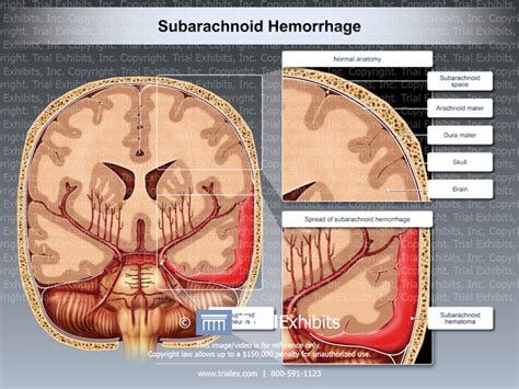 Subarachnoid Hemorrhage Coronal Cut Away View Trialexhibits Inc