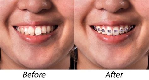 Pemasangan Kawat Gigi Ini Yang Harus Anda Ketahui Alodokter