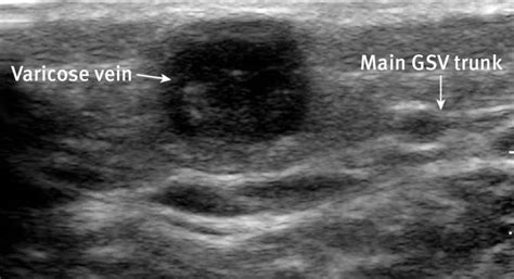 Dvt Ultrasound Made Easy Step By Step Guide Pocus 101