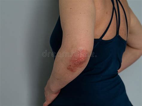 Scaly Elbow Stock Photos Free And Royalty Free Stock Photos From Dreamstime