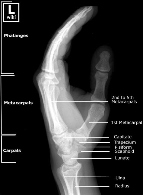 Hand Radiographic Anatomy Wikiradiography