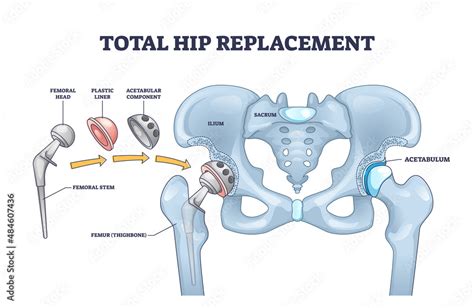 Total Hip Replacement Surgery With Anatomical Acetabular Prosthesis Outline Diagram Labeled