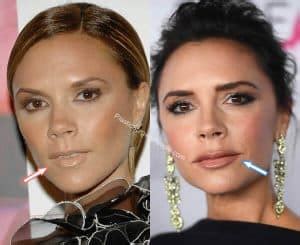 Victoria Beckham BEFORE And AFTER