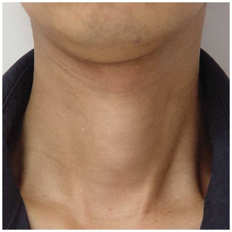 Inflamed Thyroid In Neck Twothreesixonenineeightseven