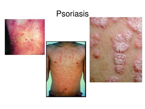 Ppt Psoriasis Powerpoint Presentation Free Download Id6581799