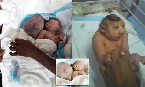 Anencephaly The Babies Born Without Brains