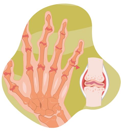 Artritis Reumatoide S Ntomas Tratamiento Y Diagn Stico Imske