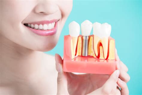 Implantes Dentales de Carga Inmediata - NATURADENT