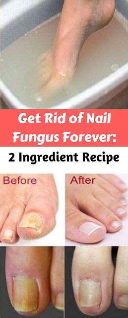 Get Rid Of Nail Fungus Forever 2 Ingredient Recipe Better Health