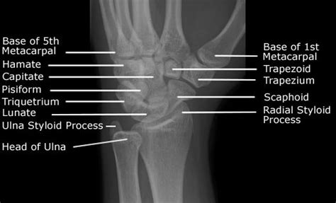 Radiographic Anatomy Wrist Oblique Radiographic Anatomy Pinterest