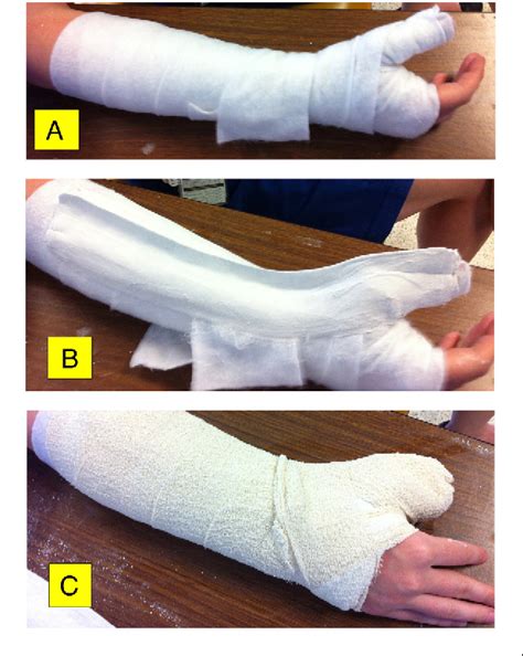 Application Techniques For Plaster Of Paris Back Slab Resting Splint And Thumb Spica Using